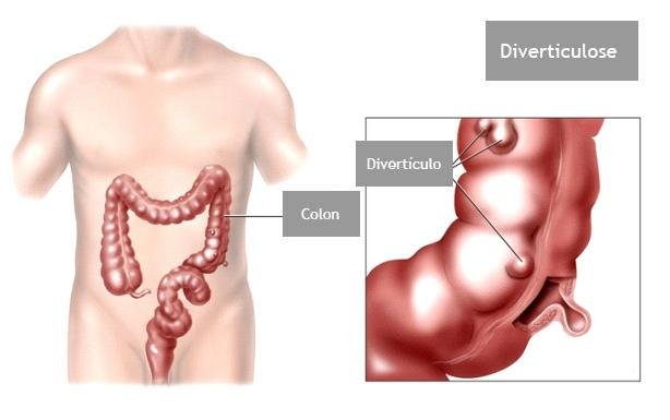 ColonDivertículos na colonoscopiaoscopia