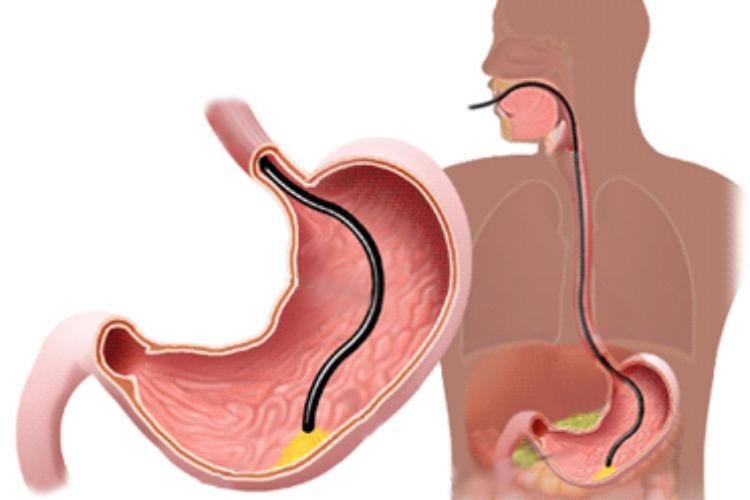 Endoscopia digestiva alta