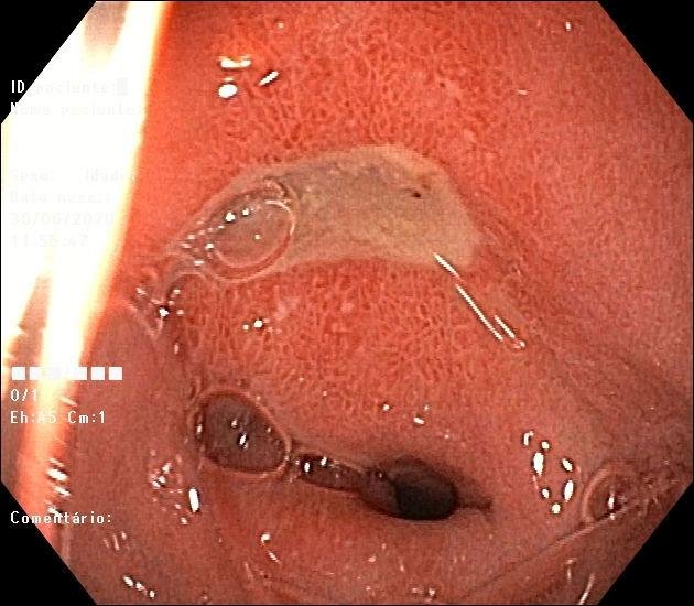 Úlcera no duodeno na endoscopia